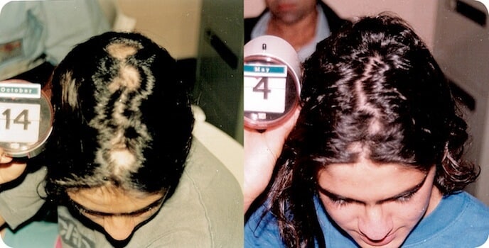 Alopecia Areata before & after
