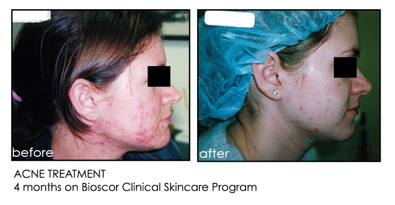 bioscor acne before and after