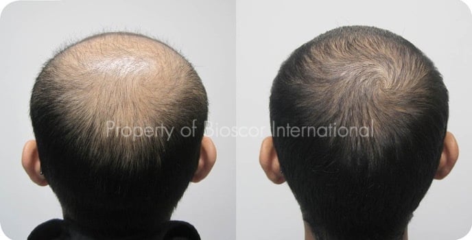 Hair Regrowth Natural Treatment | Bioscor International