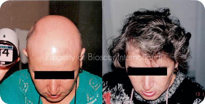 totalis befor & after treatment - Bioscor International