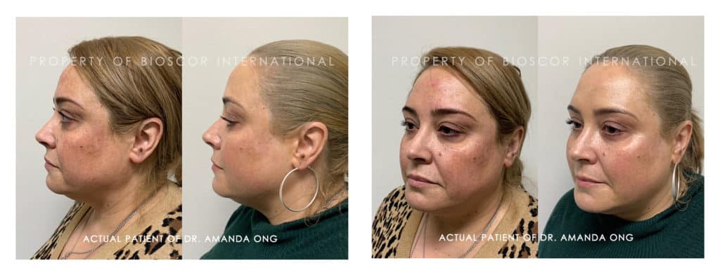 (Before and after) Actual patient of Dr. Amanda Ong from Bioscor International - non-surgical collagen-stimulating thread lifts