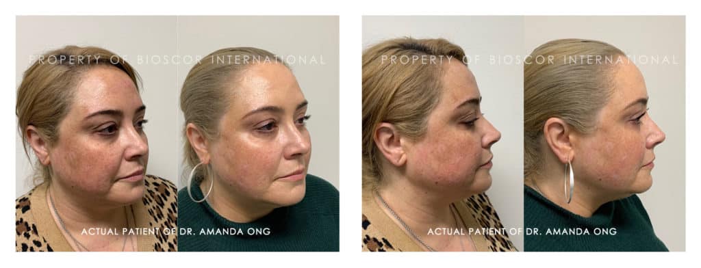 (Before and after) Actual patient of Dr. Amanda Ong from Bioscor International - non-surgical collagen-stimulating thread lifts