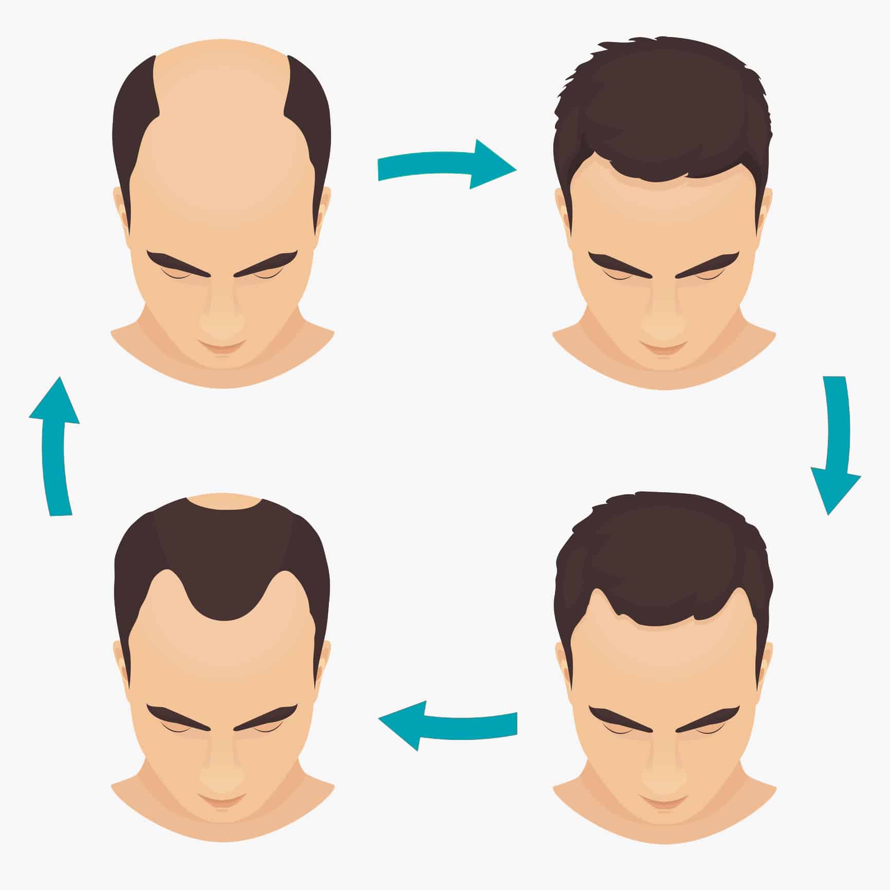 Hair Loss In Men | Bioscor International