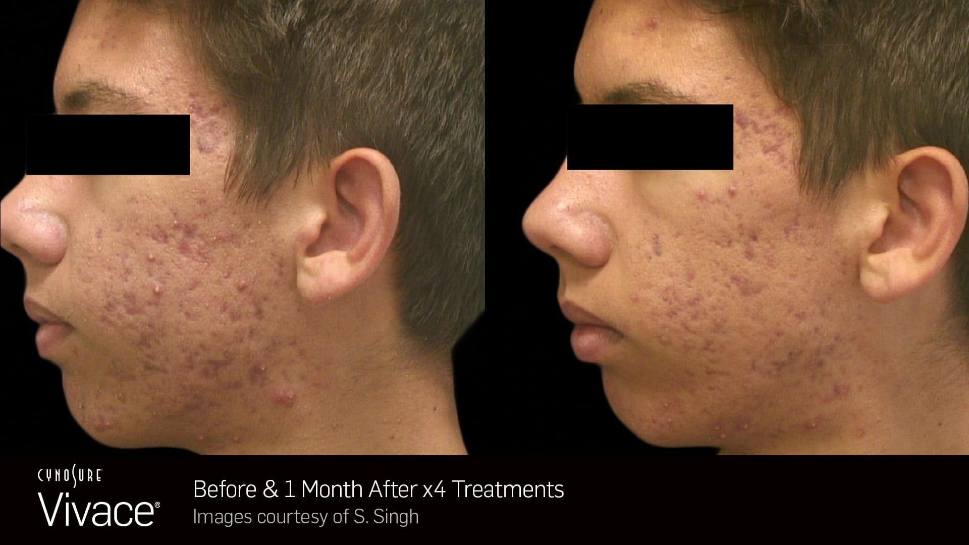 Vivace Treatment Before and After - Bioscor International