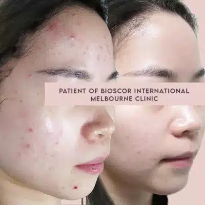 Acne Treatment Melbourne